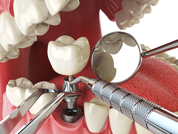 Best Emergency Root Canal Treatment in Jarales, NM